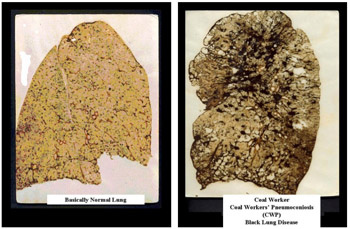 Black lung leaves miners' lungs scarred, shriveled, and black. A normal lung (left) and a diseased lung (right.) Photo by NIOSH